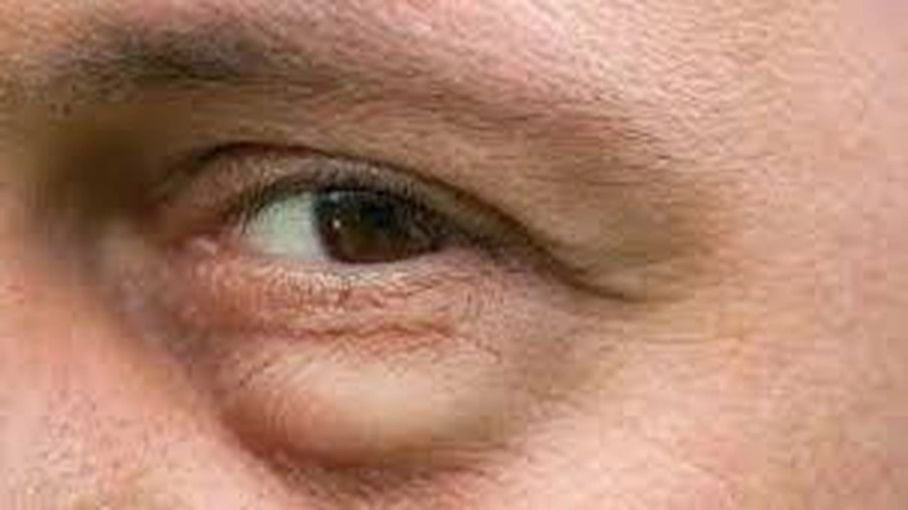 صورة انتفاخ تحت العينين : علاجات منزلية للتخلص من الانتفاخ تحت العينين 