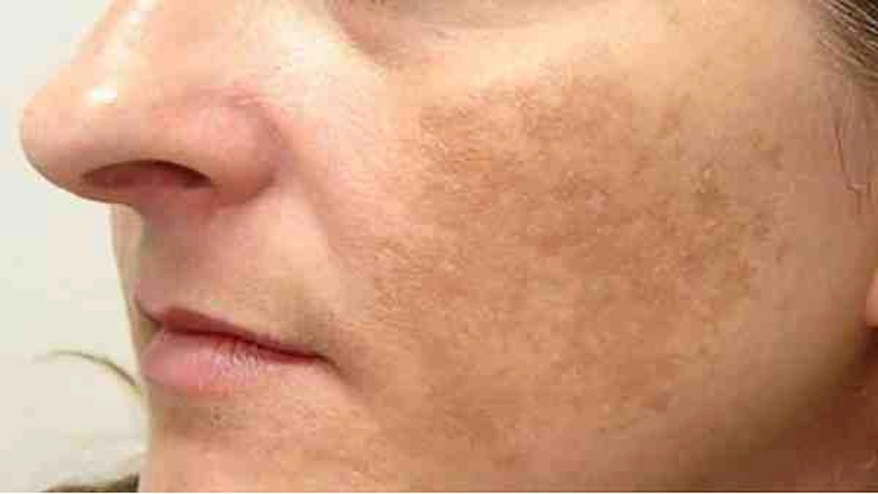 صورة خلطة مضمونة للكلف العميق