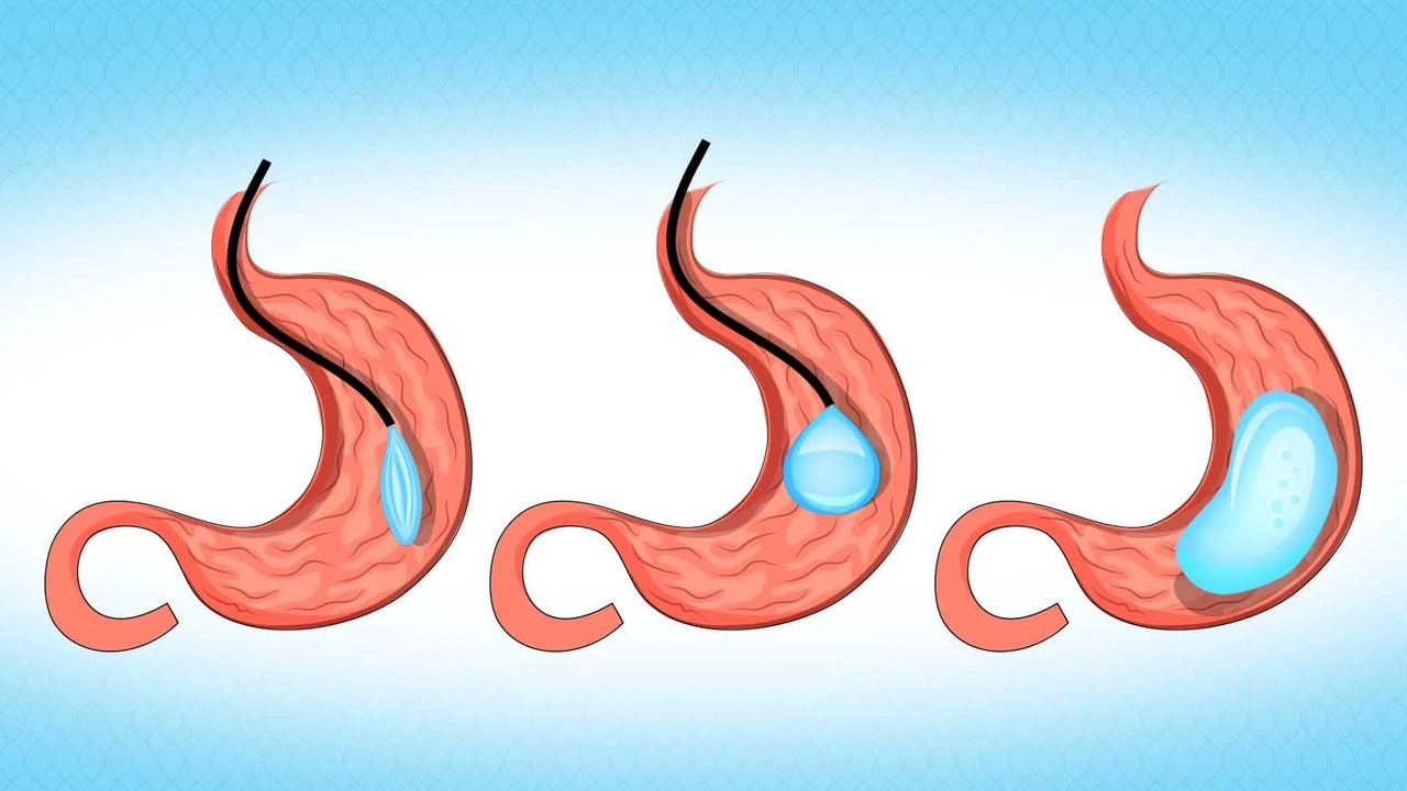 صورة مين جربت بالون المعدة ونحفت