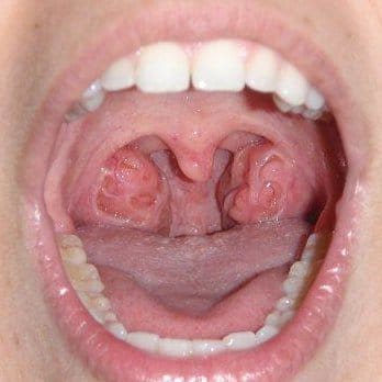 أفضل مضاد حيوي لعلاج التهاب اللوزتين
