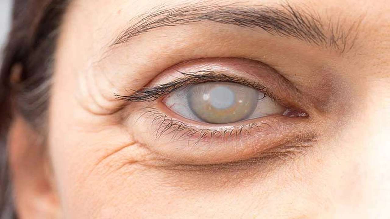 صورة إزالة غشاء العين