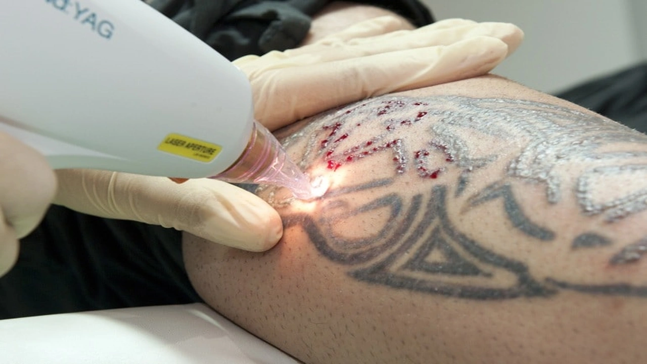 صورة ازالة تاتو بالقصيم