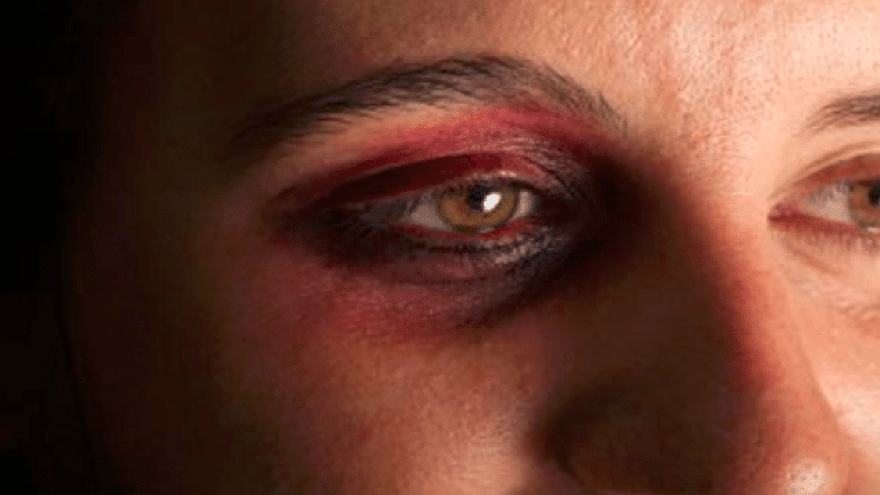 صورة ازالة كدمات العين