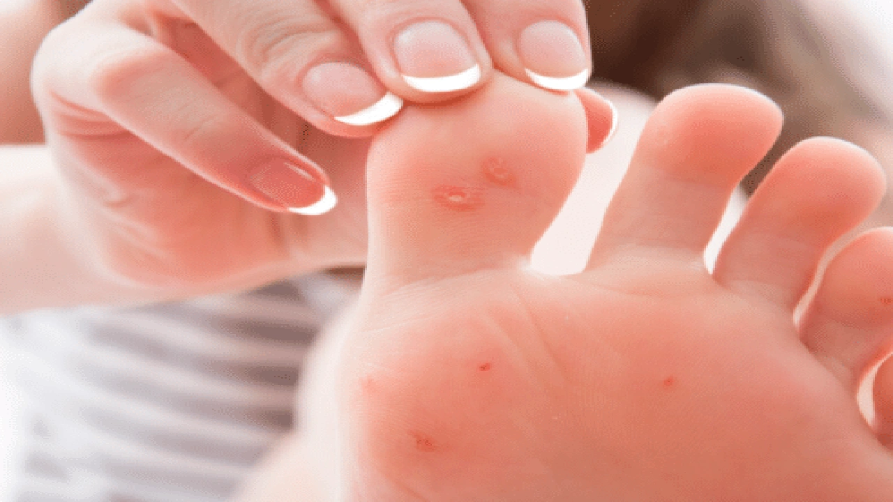 صورة ازالة مسمار القدم