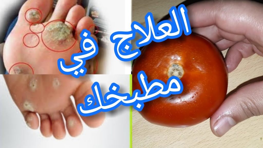 ازالة مسمار الكيف من اليد