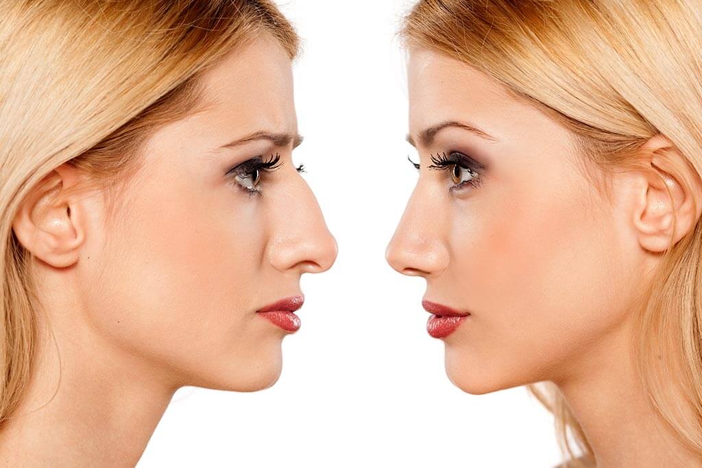 افضل دكتور تجميل انف بالشرقيه