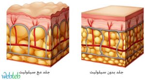 السيلوليت أسبابه وعلاجه 