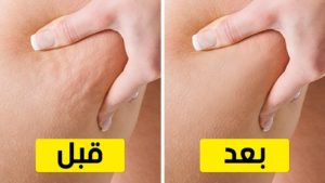 العلاجات المنزلية للتخلص من السيليوليت