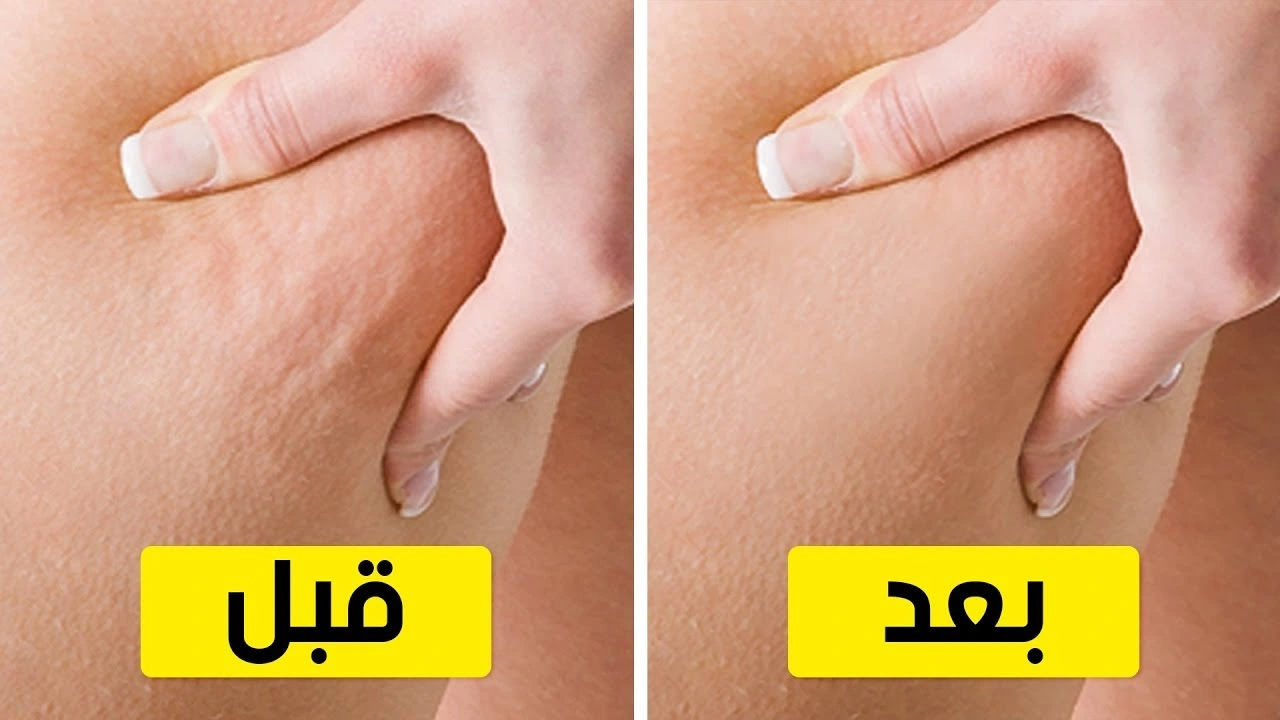صورة العلاجات المنزلية للتخلص من السيليوليت