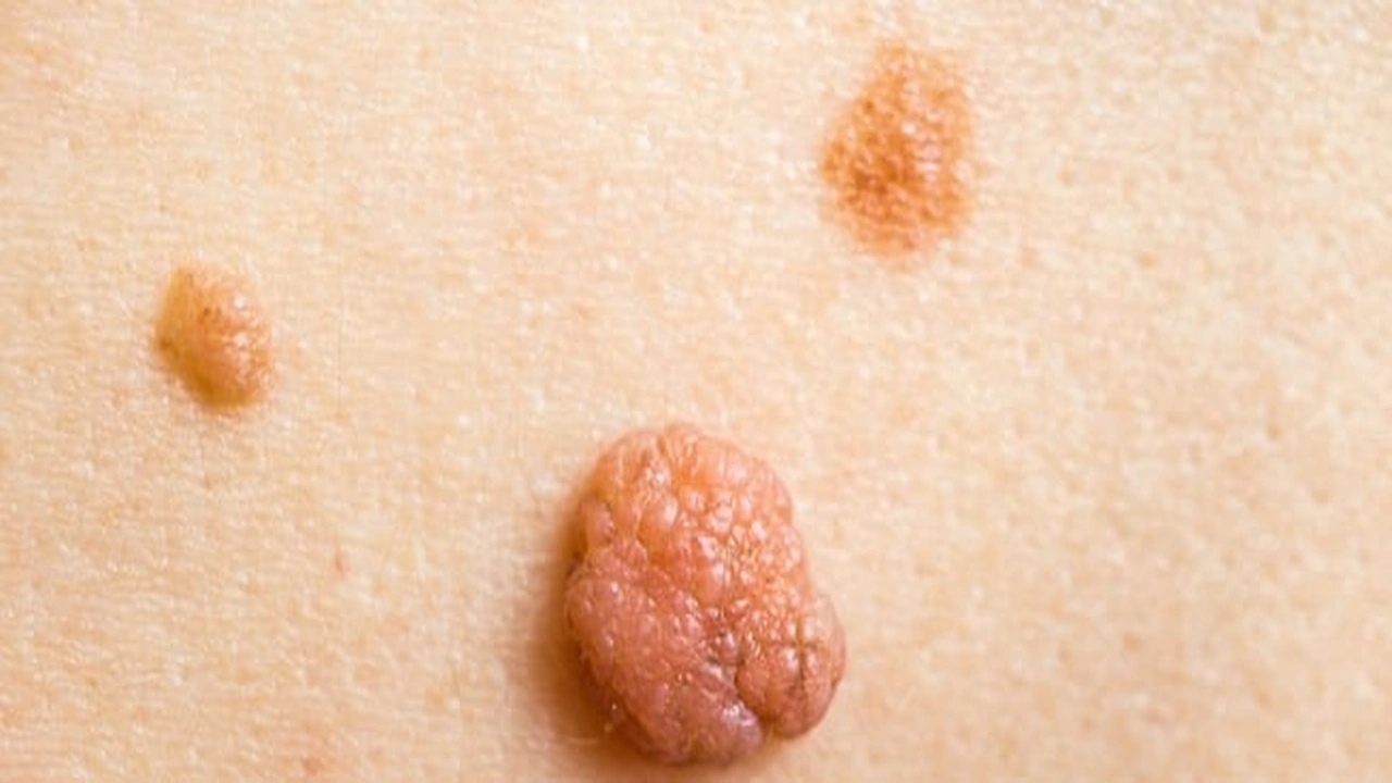 صورة الفرق بين الزوائد الجلدية والثاليل