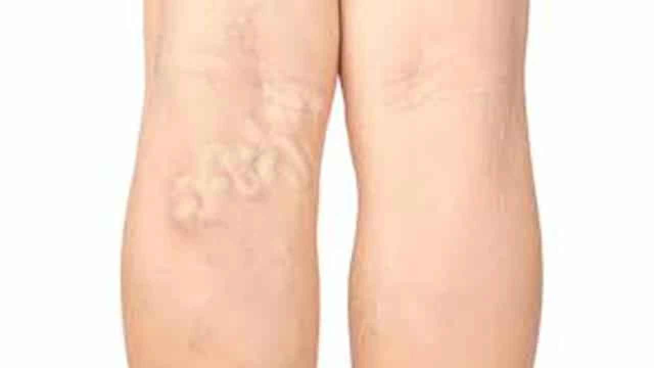 صورة الوصفة الثانية لعلاج دوالي الساقين 