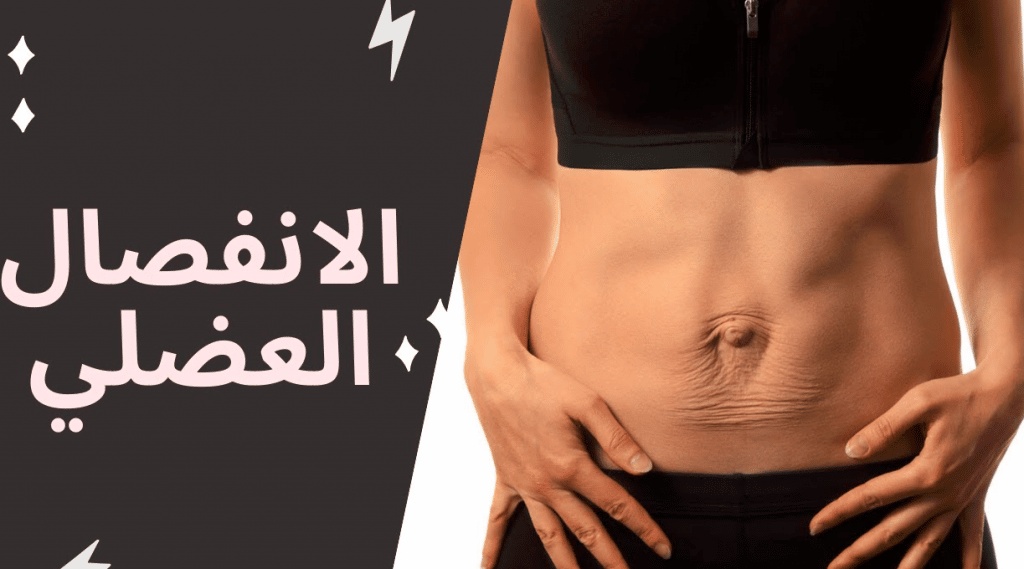 تجاربكم مع الانفصال العضلي للبطن