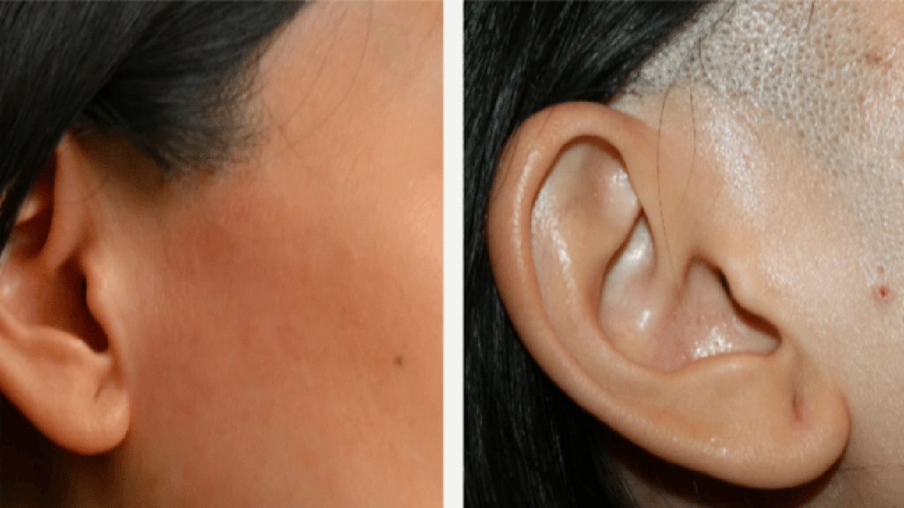 صورة تجاربكم مع الشعر الوبري بالليزر