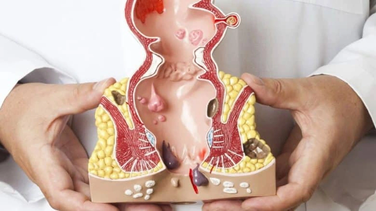 صورة تجاربكم مع علاج البواسير