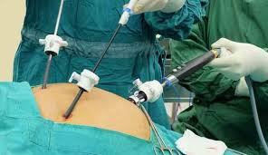 تجربتي في تفتيت حصوة المرارة