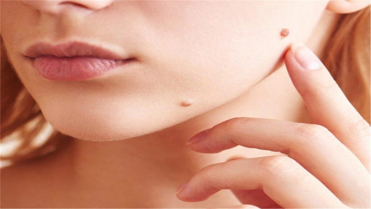 صورة تجربتي في علاج الثالول