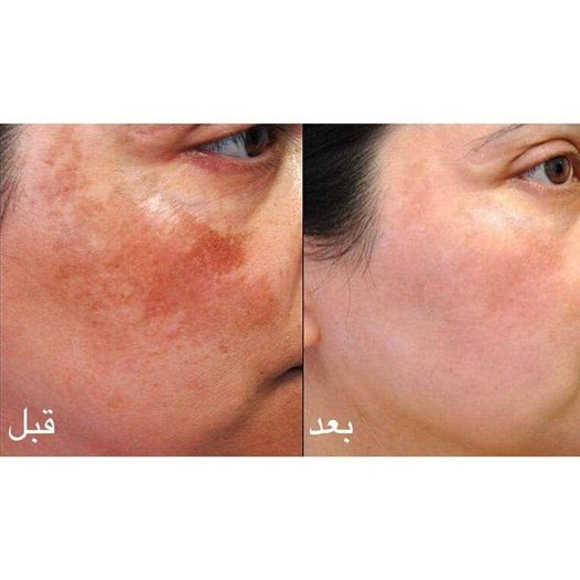تجربتي مع الميزوثيرابي للبشرة