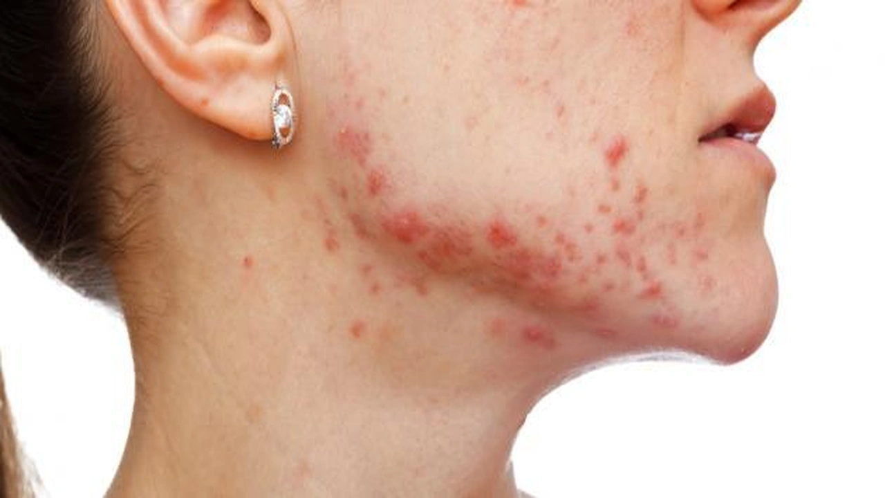 صورة تجربتي مع علاج الحبوب تحت الجلد