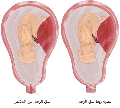 تجربتي مع عملية ربط عنق الرحم