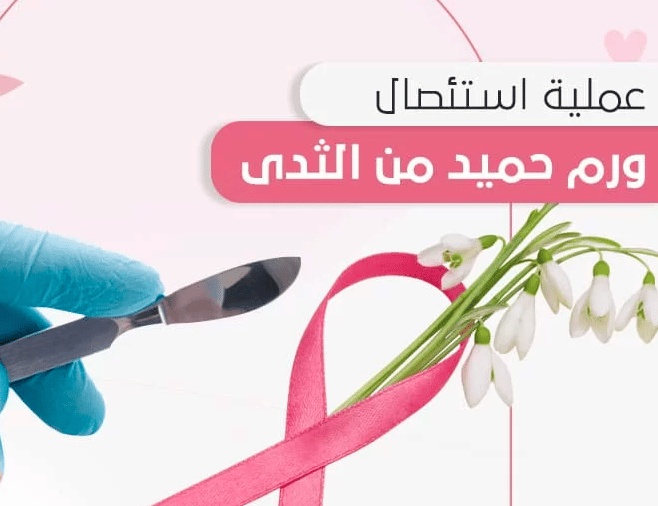 تجربتي مع ورم الثدي الحميد