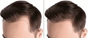 زراعة الشعر في تركيا