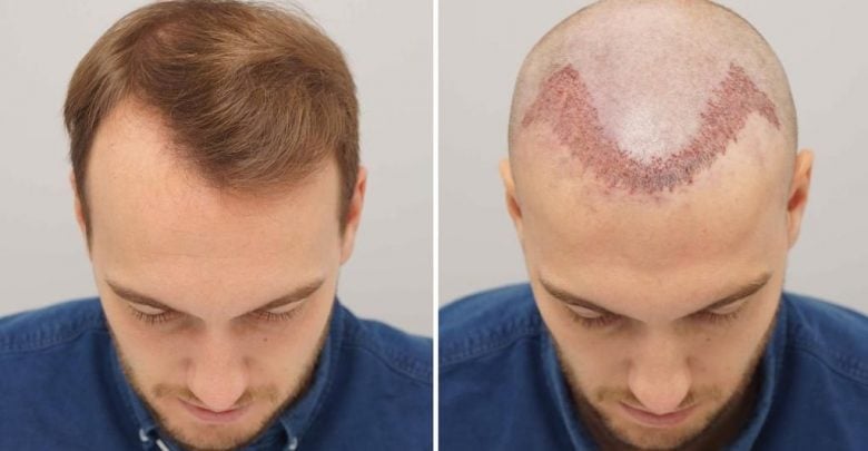 زراعة الشعر في تركيا