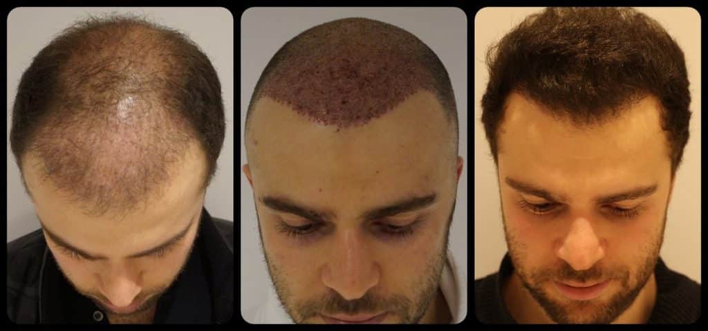 زراعة الشعر في تركيا