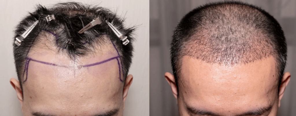 زراعة الشعر في تركيا