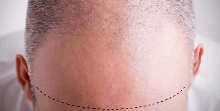 زراعة الشعر في تركيا
