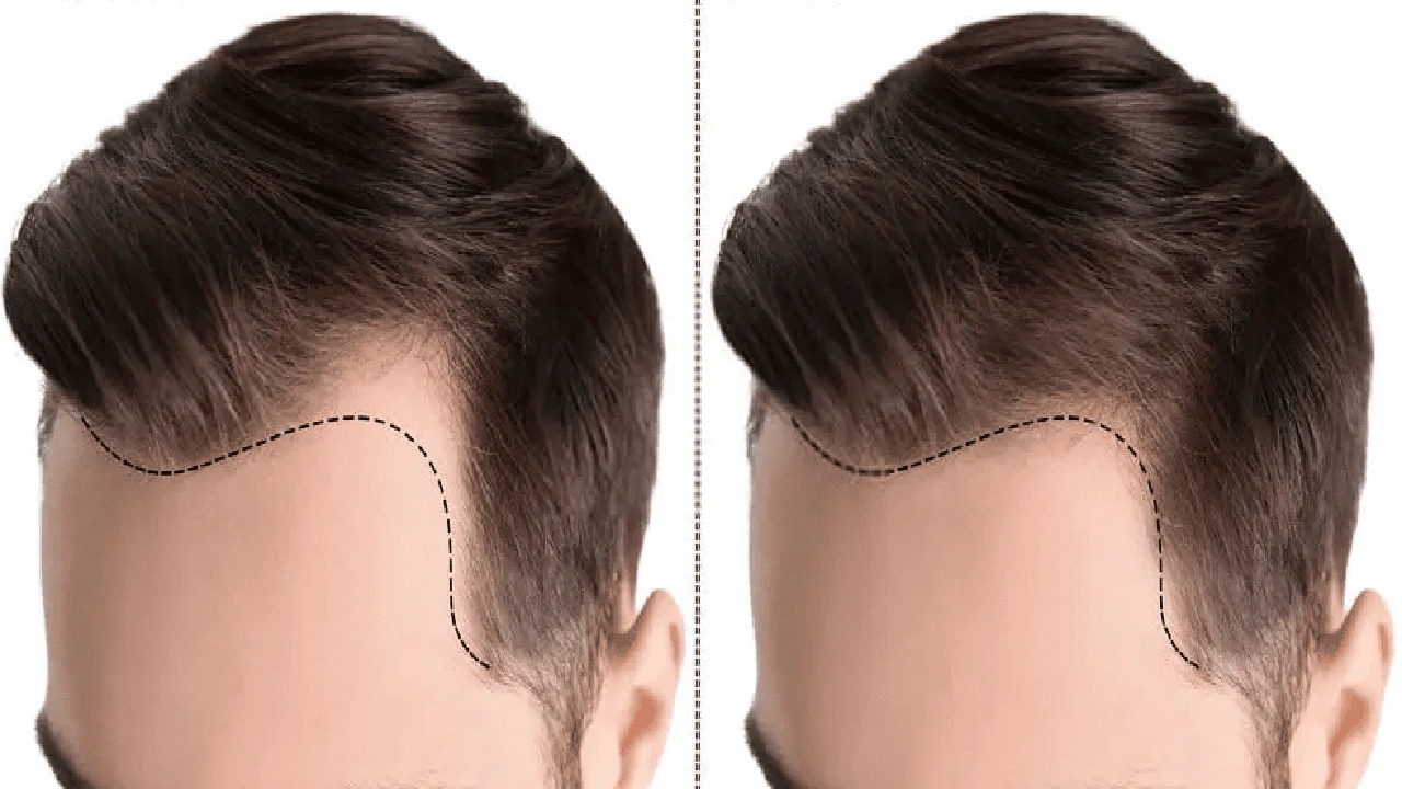 صورة زراعة الشعر في تركيا