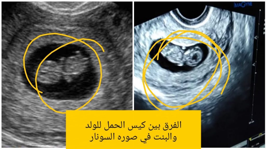 شكل كيس الجنين الذكر في الشهر الثاني