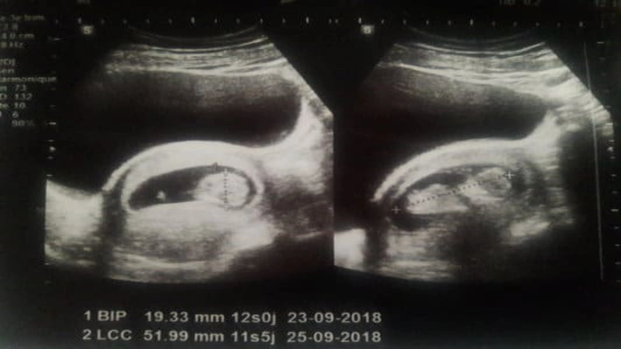 صورة شكل كيس الجنين الذكر في الشهر الثاني