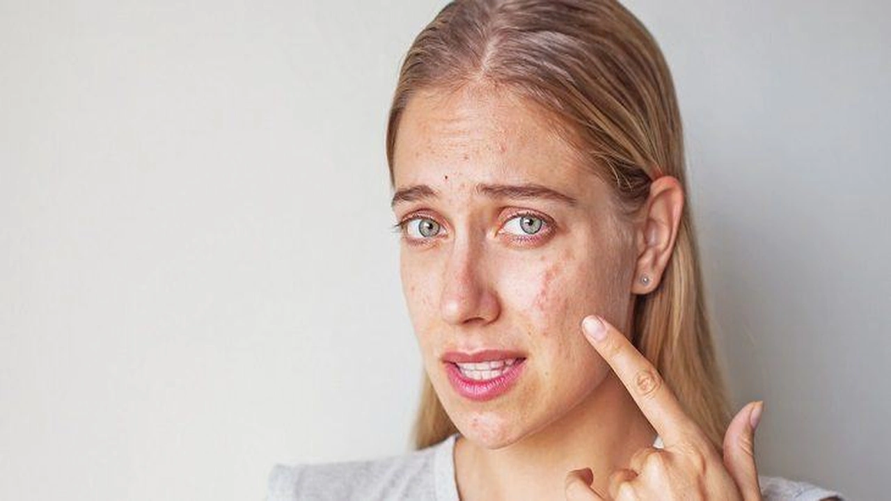 صورة علاج بقع حب الشباب : أفضل طريقة لعلاج بقع حب الشباب