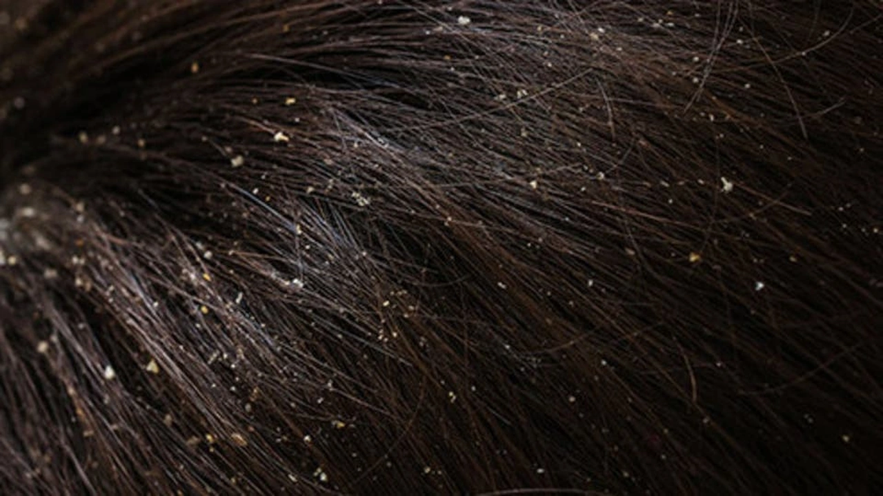 صورة علاج قشرة الرأس بشكل طبيعي : 9 علاجات منزلية لعلاج قشرة الرأس بشكل طبيعي 