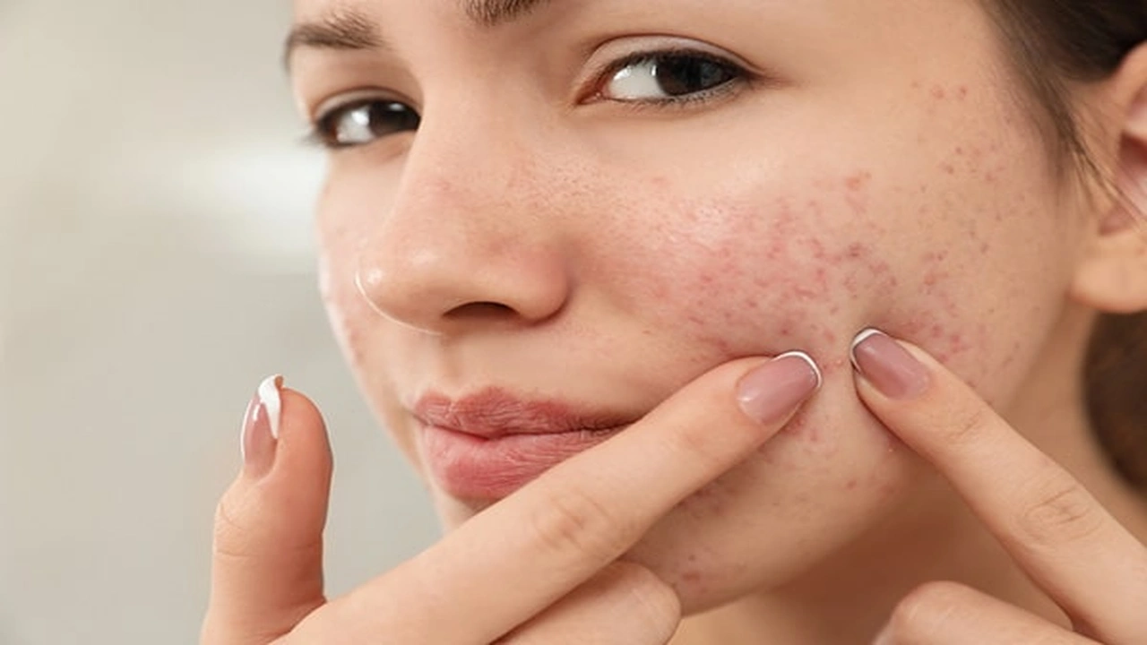 صورة كيفية استخدام acne stop
