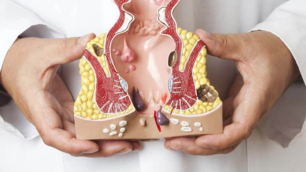 صورة كيفية علاج البواسير بسرعة