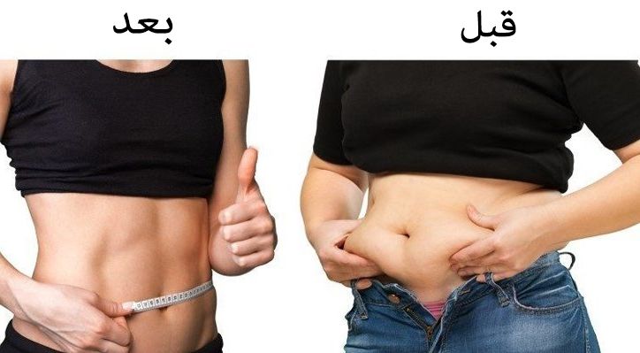 متى تظهر نتيجة عملية شد البطن