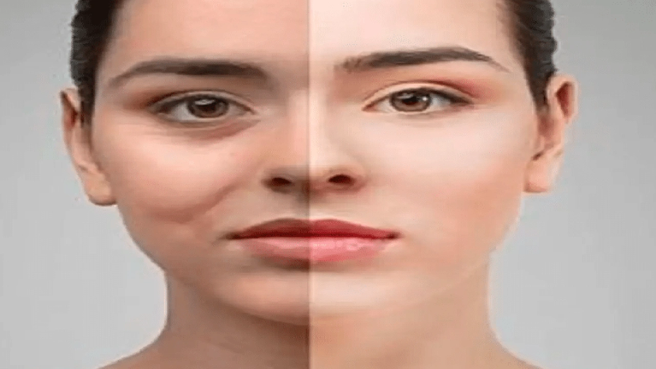 صورة متى تظهر نتيجة عملية شد الجفون