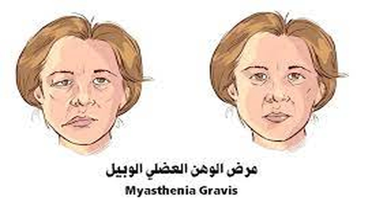 صورة نصائح لمرضى الوهن العضلي