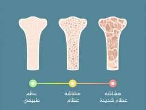 نصائح لهشاشة العظام