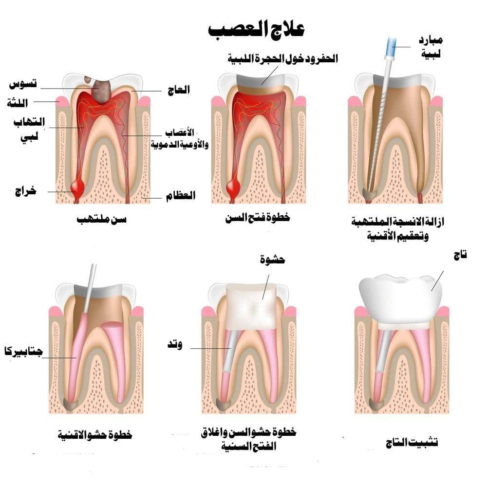 هل يزول الالم بعد سحب العصب