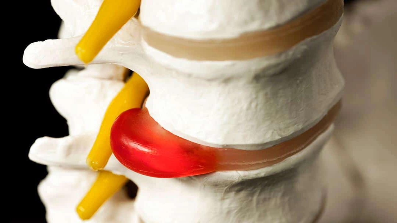 صورة هل يزول الانزلاق الغضروفي