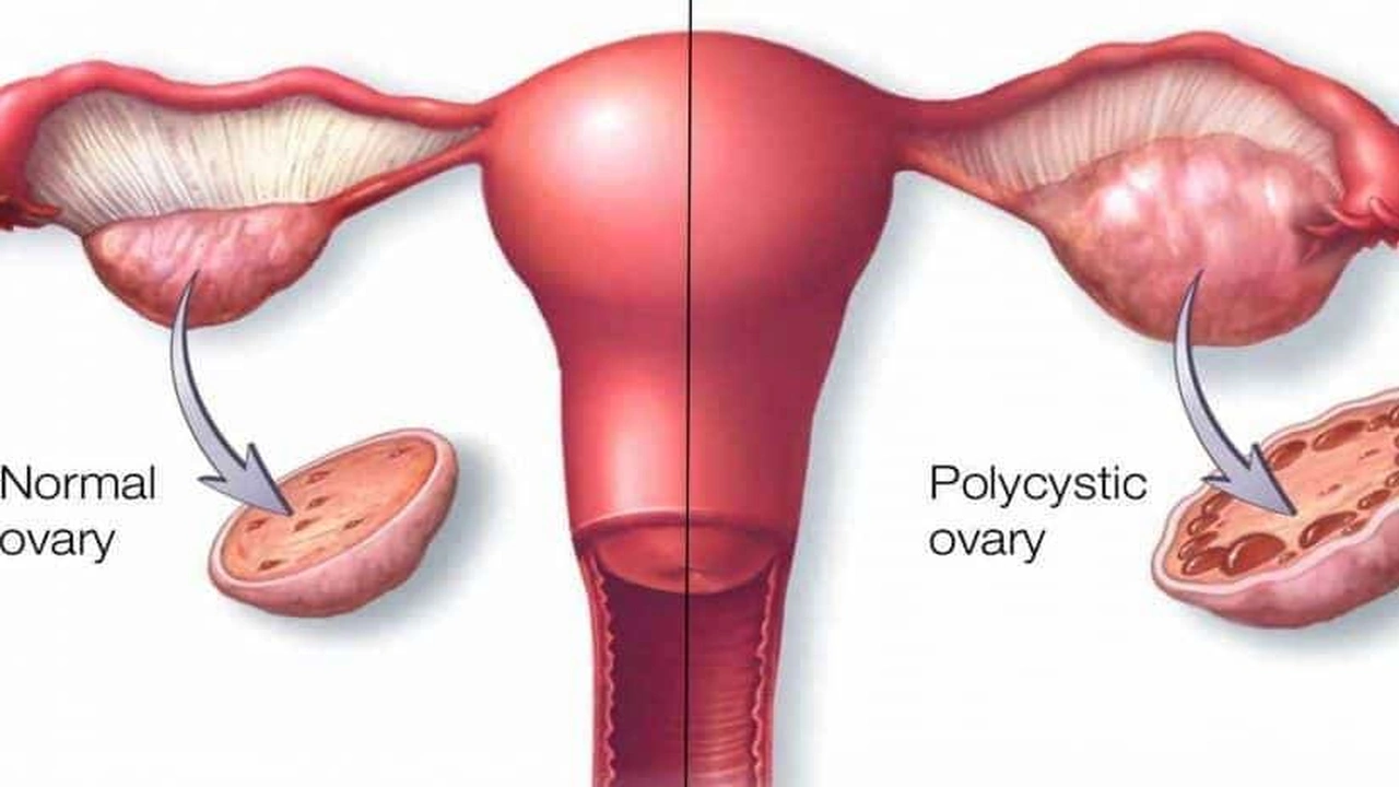 صورة هل يزول الشعر بعد علاج تكيس المبايض
