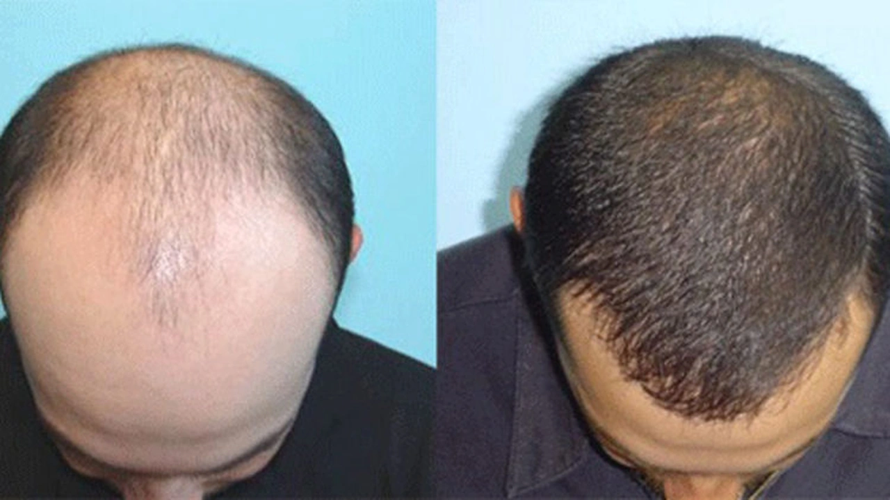 صورة 17 علاجات لتساقط الشعر و الصلع عند الرجال