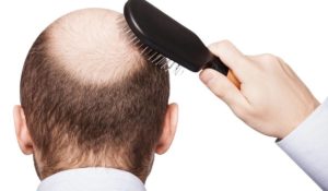 أسباب تساقط الشعر للرجال