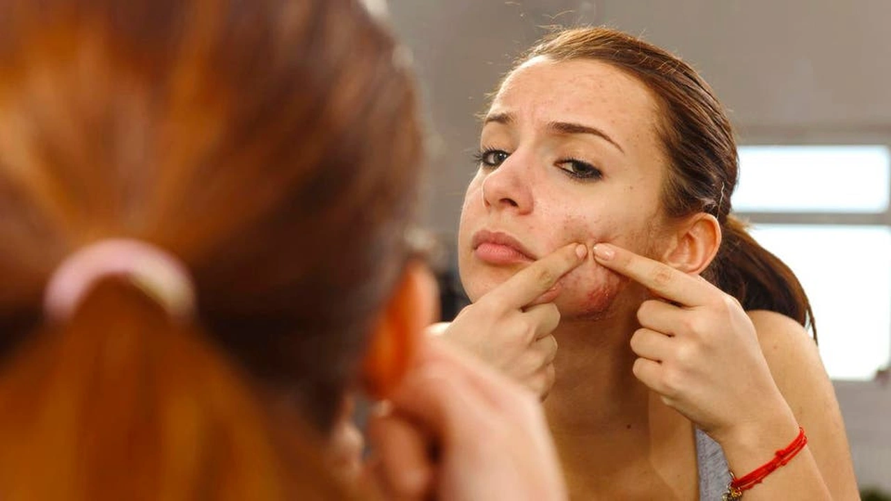 صورة أفضل 12 علاج منزلي لحب الشباب