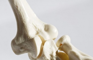 أفضل علاج مجرب لهشاشة العظام