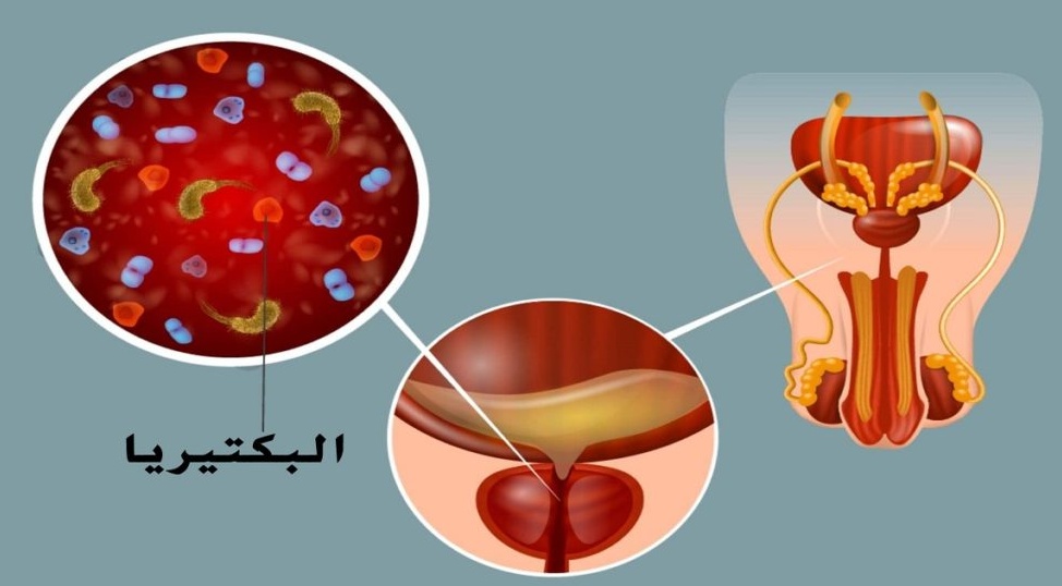 أفضل مضاد حيوي لعلاج التهاب البروستاتا