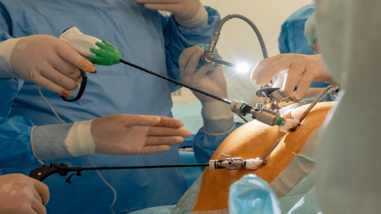 صورة إرشادات بعد إجراء عملية فتق جراحي وتركيب شبكة