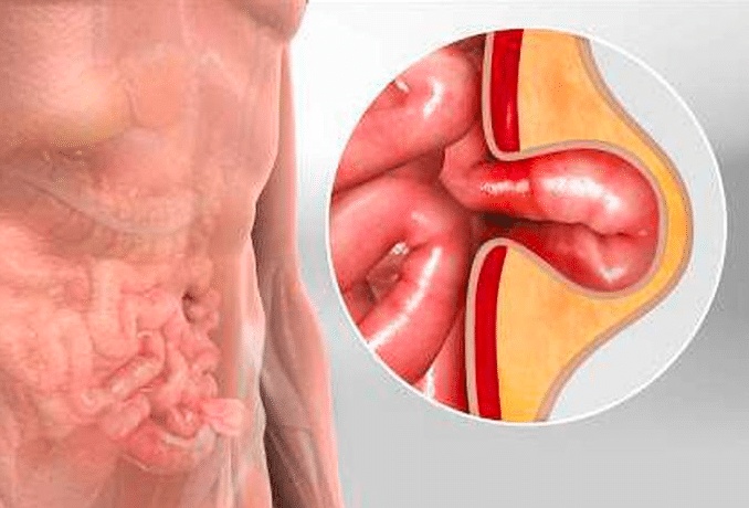 إرشادات بعد إجراء عملية فتق جراحي وتركيب شبكة